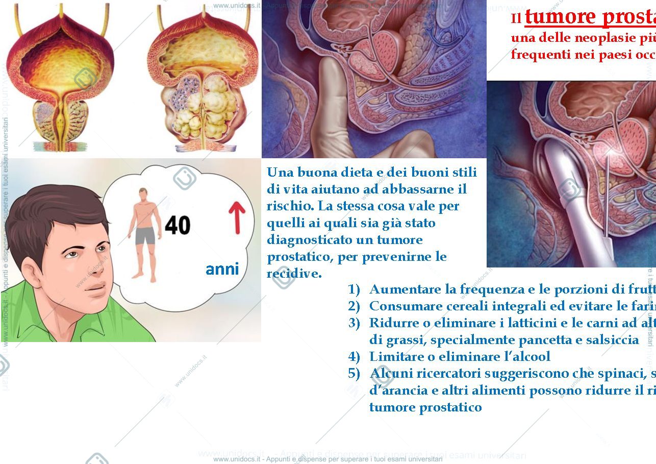 Anteprima pagina 2 — Té verde e carcinoma prostatico